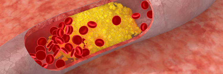 dieta a cholesterol